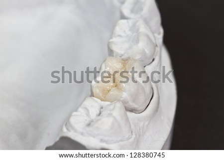 closeup for dental onlay on a molar tooth shown on a plaster model Royalty-Free Stock Photo #128380745
