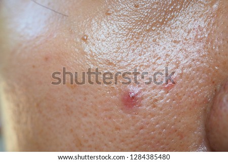 Pimple and acne on face skin and nose, zoom macro. Oily pore skin. Royalty-Free Stock Photo #1284385480