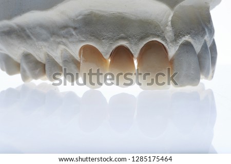 Dental crowns three jaw model, photographed on a white background