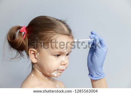 Closeup face of cute little girl with varicella virus or chickenpox bubble rash, doctor's hand in rubber glove with cotton swab covering red spots zinc lotion calamine. Concept quarantine kindergarten