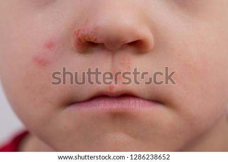 Close up of herpes breakout on boys face around nose and upper lip.  Royalty-Free Stock Photo #1286238652