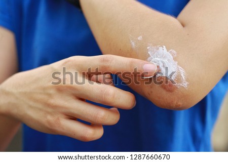 Close up at Asian woman's hand is applying medical cream at  Keloid scar (Hypertrophic Scar) at her elbow cause by bicycle accidental.Concepts of health care and beauty. Royalty-Free Stock Photo #1287660670