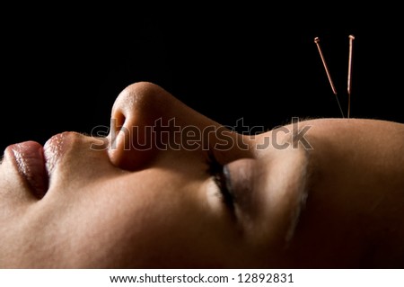 Woman getting an acupuncture treatment in a spa Royalty-Free Stock Photo #12892831
