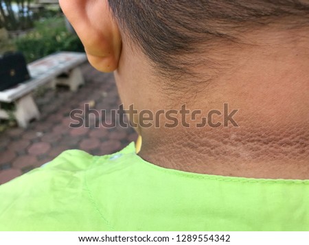 Black marks at the neck Royalty-Free Stock Photo #1289554342