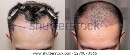 Top view of a man's head with hair transplant surgery with a receding hair line. - Before and After Bald head of hair loss treatment. Royalty-Free Stock Photo #1290073366
