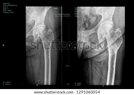 Necrosis of the femoral head and progress of the healing process of greater trochanter fracture Royalty-Free Stock Photo #1291060054