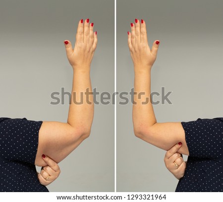 Adipose panniculus in the triceps before and after diet Royalty-Free Stock Photo #1293321964