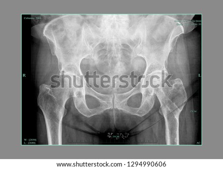X-ray of the pelvis and femoral head necrosis  Royalty-Free Stock Photo #1294990606