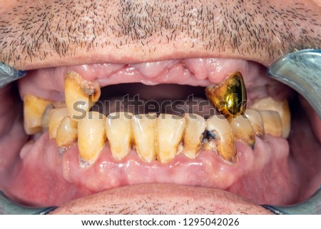 patient's bad teeth at the dentist's dentist close-up macro. Caries, plaque harm smoking