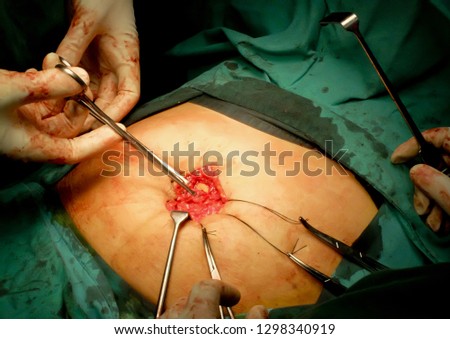 Suturing the fascia in Umbilical hernia repair. Royalty-Free Stock Photo #1298340919