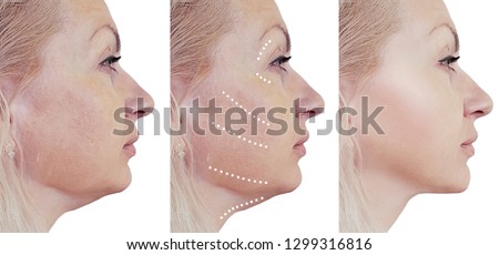 woman double chin before and after procedures Royalty-Free Stock Photo #1299316816