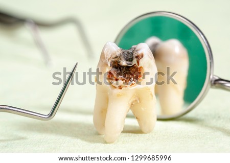 extracted molar tooth with caries and amalgam Royalty-Free Stock Photo #1299685996