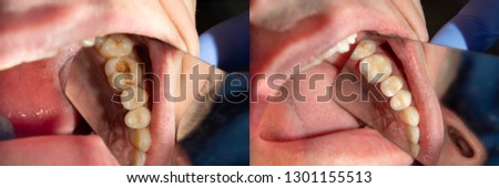 Dental caries. Filling with dental composite photopolymer material using rabbders. The concept of dental treatment in a dental clinic Royalty-Free Stock Photo #1301155513