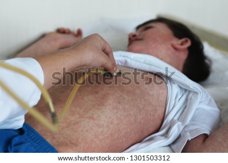 Measles rash. Doctor and patient
