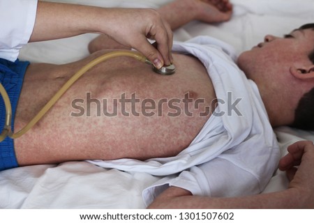 Measles outbreak, vaccination or epidemic concept. Doctor with stethoscope and child with rash pimples pustules Royalty-Free Stock Photo #1301507602