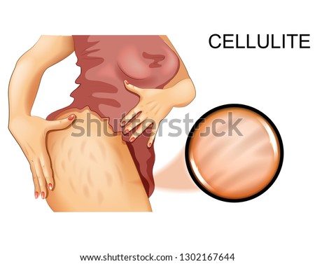 vector illustration of cellulite on a woman's thigh