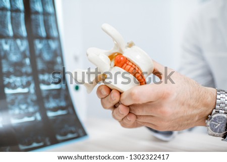 Close-up of therapist holding anatomical model of vertebras with intervertebral hernia