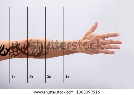 Laser Tattoo Removal On Man's Hand Against White Background Royalty-Free Stock Photo #1303099516