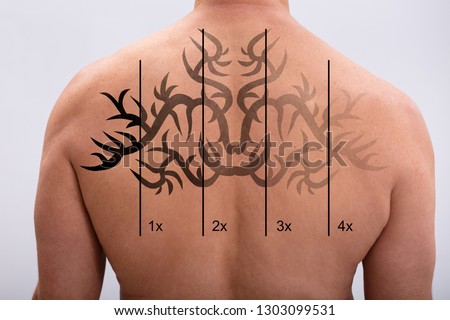 Rear View Of A Man With Laser Tattoo Removal On White Background Royalty-Free Stock Photo #1303099531
