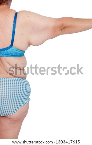 Middle aged woman with sagging excess arm skin after extreme weight loss. Before brachioplasty, panniculectomy, abdominoplasty and mummy makeover. Back view part right arm. Royalty-Free Stock Photo #1303417615