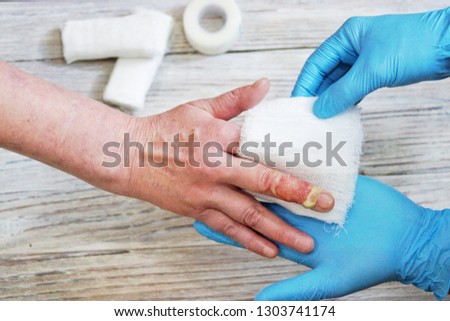 the doctor puts a bandage with the medicine on the burn of the fingers of the woman's hand, an accident at home, careless behavior with boiling water, an injured hand Royalty-Free Stock Photo #1303741174