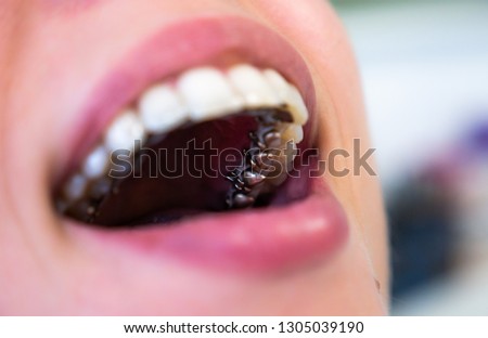  lingual ingognito braces teeth Royalty-Free Stock Photo #1305039190