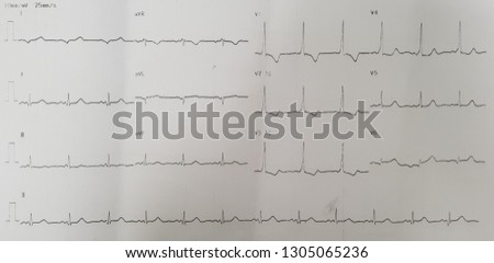 Wolff Parkinson White syndrome (WPW) type A. Left lateral accessory pathway. Royalty-Free Stock Photo #1305065236