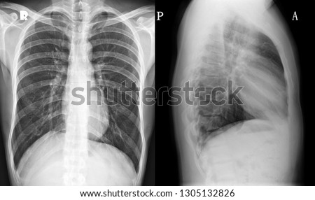 Normal  Chest X-ray (High Resolution)/ PA& Lateral Lung /Many Other Radiological Images (CT, MRI, PET CT, X-ray) in my portfolio