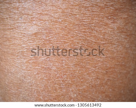 Dry skin or ichthyosis texture detail on leg women using for skincare and moisturizer lotion, cream or cosmetics product concept, Macro shot photo. Royalty-Free Stock Photo #1305613492