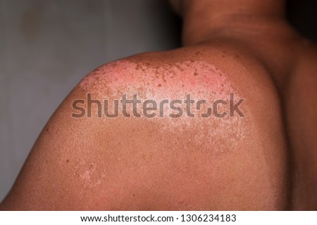 man with reddened, itchy skin after sunburn.