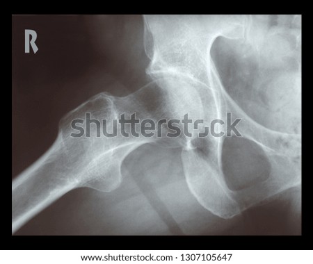 X-ray of female right hip Royalty-Free Stock Photo #1307105647