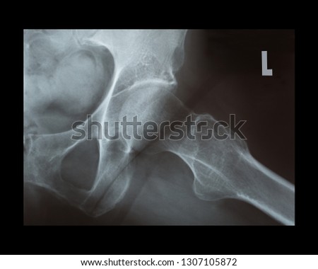 X-ray of female left hip Royalty-Free Stock Photo #1307105872