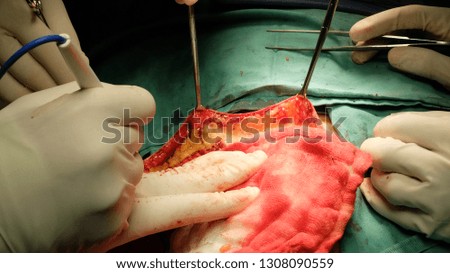 Surgeon performing incision on skin flap using diathermy.