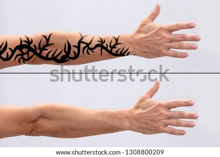 Laser Tattoo Removal On Man's Hand Against White Background Royalty-Free Stock Photo #1308800209