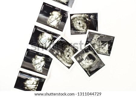 Ultrasound of baby in mother's womb. Concept of pregnancy, health care, gynecology, medicine. Mother waiting of the baby. Close-up.