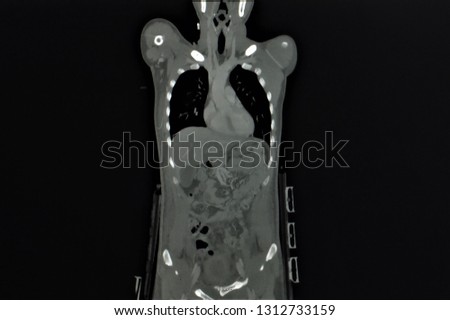 a coronal view of whole body magnetic resonance image or MRI  showing internal organ such as heart, lung, liver, intestine on black background 