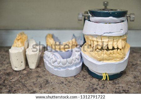 Gypsum model with teeth stump and implant