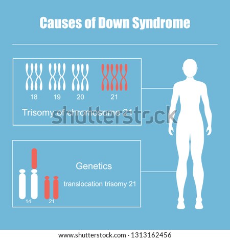 Causes of Down Syndrome.Trisomy of chromosome 21.Vector illustration Royalty-Free Stock Photo #1313162456