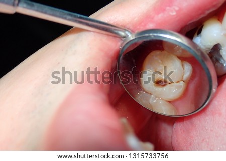 A dental tooth decay cavity found during routine dental examination check up using a dental mirror Royalty-Free Stock Photo #1315733756