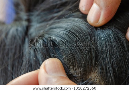 Lice eggs on the child's head cause head itching. Girls with long hair are more likely to develop lice than short hair.