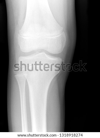 X-ray medical picture - Human knee