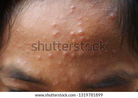 The girl had a blister on the face due to a virus infection, chickenpox