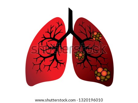 Difference between human normal lungs and  lungs cancer cause of smoking.Human lungs anatomy and structure isolated on white background. Lung cancer and normal lung vector