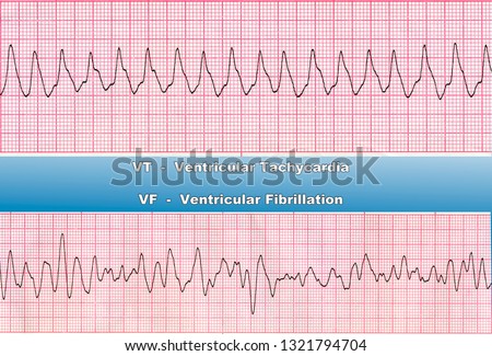 Ventricular Tachycardia (VT) -  is fast heart rhythm, that originates in one of the ventricles of the heart. Ventricular Fibrillation (VF) - is a cause of cardiac arrest and sudden death.  Royalty-Free Stock Photo #1321794704