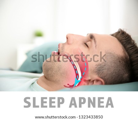 Illustration showing airway during obstructive sleep apnea Royalty-Free Stock Photo #1323433850
