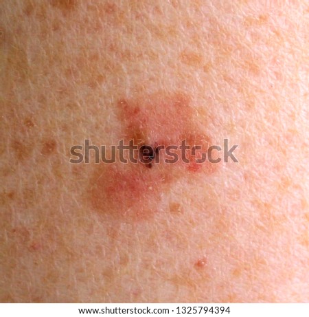 Superficial spreading melanoma. Royalty-Free Stock Photo #1325794394