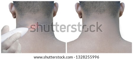 Fat man with sunburned neck.The skin is full of rash.Picture concept,
Removing wrinkles with laser.