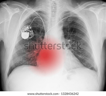 X-ray picture - Chest with pacemaker and red symbol of painful place
