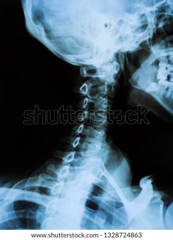 Cervical X-ray film