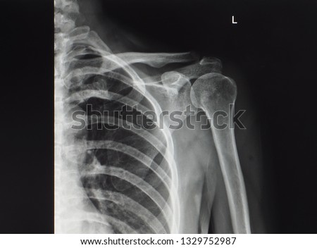 an anteroposterior radiograph or x-ray of left shoulder showing normal bone, joint and soft tissue. patient has frozen shoulder and calcific tendinitis Royalty-Free Stock Photo #1329752987